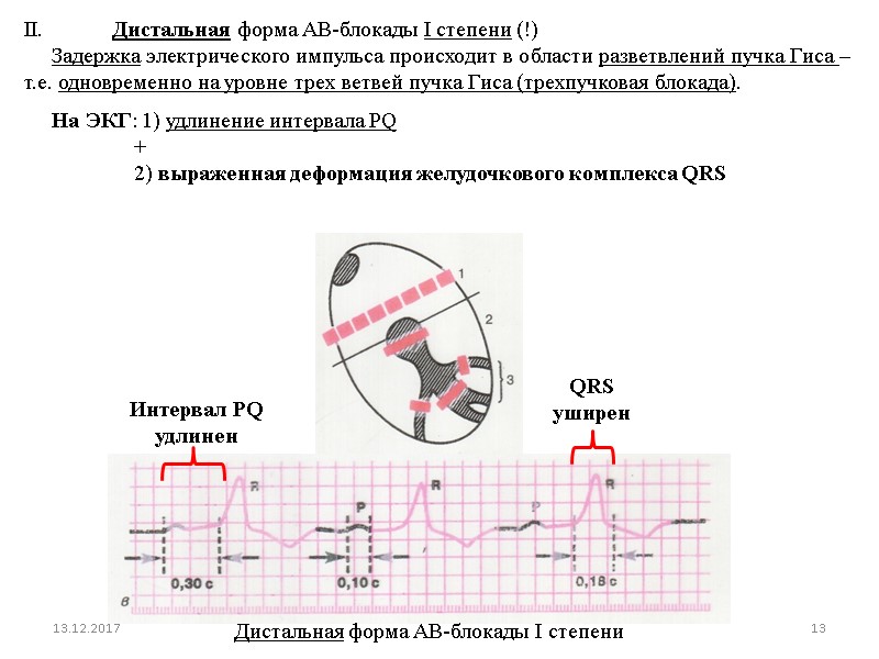 II. Дистальная форма АВ-блокады I степени (!)      Задержка электрического